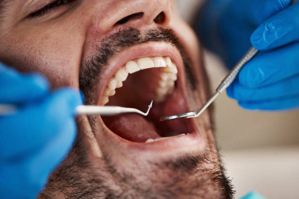Best Emergency Wisdom Tooth Extraction in Clyde Hill, WA